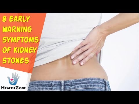 8 Early Warning Symptoms of Kidney Stones