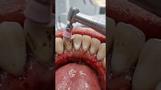 Extreme Black Tartar Removal – Satisfying Deep Teeth Clean Transformation