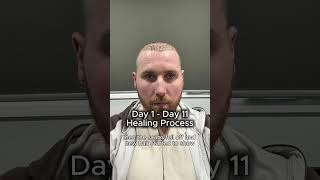 6 Months Hair Transplant Journey Real Results At Estenove