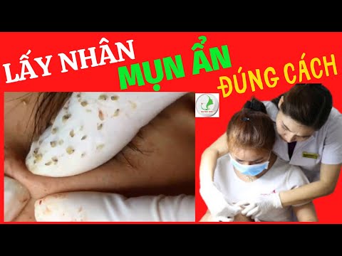 LẤY MỤN ẨN DƯỚI DA ĐƠN GIẢN  ĐÚNG CÁCH KHÔNG ĐAU |CHUYÊN GIA NGUYỄN NGỌC GIAO|