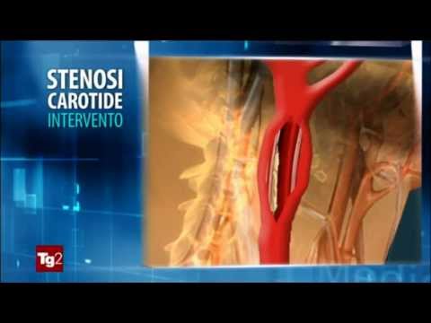 Video: Simulazione CFD Carotidea Basata Su DSA Nella Valutazione Del Paziente Con Stenosi Carotidea Asintomatica: Uno Studio Preliminare