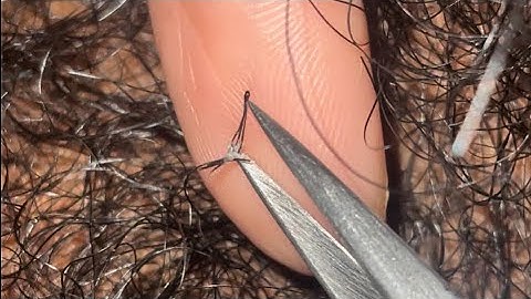 Ingrown and Compound Hair Extractions😍