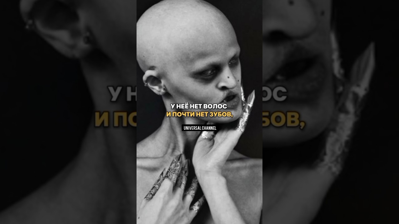 У НЕЁ НЕТ ВОЛОС И ПОЧТИ НЕТ ЗУБОВ И ОНА СТАЛА МОДЕЛЬЮ МЕЛАНИ ГАЙДОС