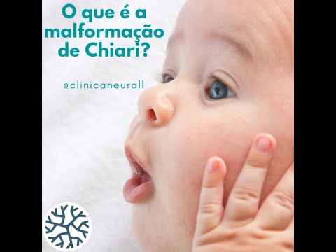 O que é a Malformação de Chiari?