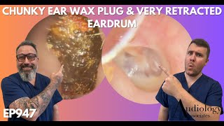 SHOCKED BY THE SIZE OF THIS EAR WAX PLUG - EP947