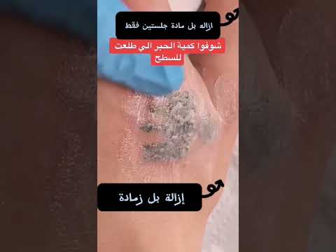 إزالة وشم من جلستين فقط بل مادة مو حبر لحميالى اصحاب الفحص الطبي الان توفر ازاله وشم جلسه وحدة فقط