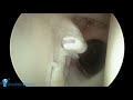 ROTATOR CUFF TRANS-TENDON ARTHROSCOPIC REPAIR
