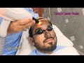 Carbon Laser Facial Treatment for Skin