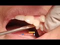 maxillary first premolar extraction right side#dentalclinic