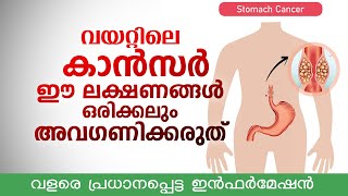 വയറ്റിലെ കാൻസർ ഈ 4 ലക്ഷണങ്ങൾ ഒരിക്കലും അവഗണിക്കരുത് | വളരെ പ്രധാനപ്പെട്ട ഇൻഫർമേഷൻ | Stomach cancer