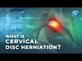 What is Cervical Disc Herniation? | Herniated Disc