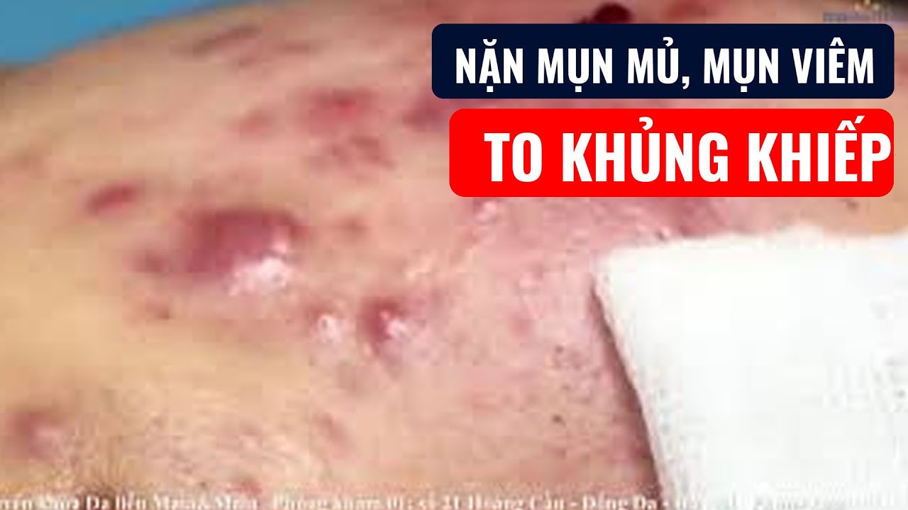 Nặn mụn mủ, mụn viêm TO KHỦNG KHIẾP