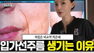 70대 초반 여성의 입가주름·팔자주름 | 쥬브젠 자가진피재생술 적용 사례