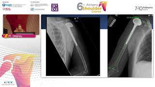3D planning for reverse shoulder arthroplasty. Why and how to plan: Ruth Delaney