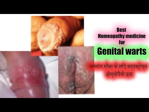 Genital warts  जननांग मौसा   best homeopathy medicine all types warts and corns A31 warts drops