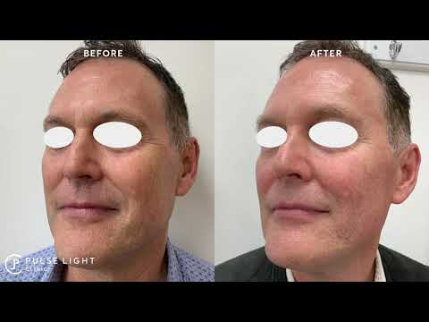 NON-SURGICAL FACELIFT - PROFOUND RF TREATMENT