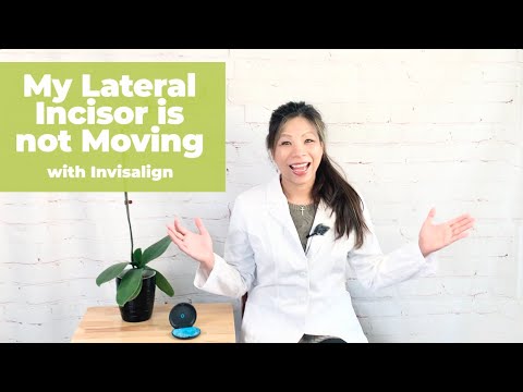 My Lateral Incisor is not following with the Invisalign trays!_ Dr. Yang's Invisalign Journey (7)