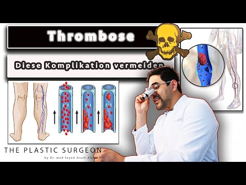 Die Thrombose und Lungenembolie erkennen als GEFÄHRLICHE Komplikation - Helfen Kompressionsstrümpfe?
