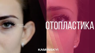 Отопластика - Мои Результаты | Otoplasty - My Results Отопластика - Мои Результаты | Otoplasty - My Results