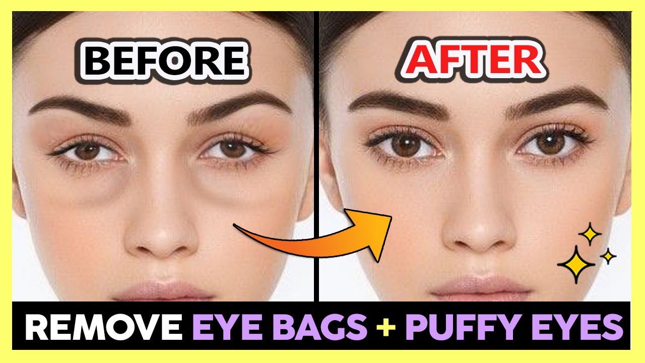 ✨ REMOVE UNDER EYE BAGS, PUFFY EYES, SWOLLEN EYES PERMANENTLY