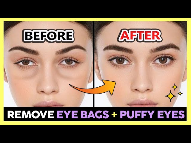 ✨ REMOVE UNDER EYE BAGS, PUFFY EYES, SWOLLEN EYES PERMANENTLY | GET BRIGHT EYES & BEAUTIFUL EYES