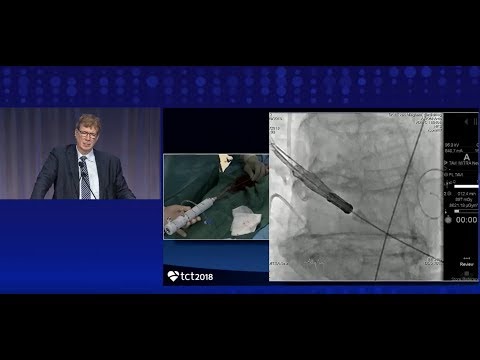 Video: Awake Video-Assisted Surgery Option Für "inoperable" Lungen