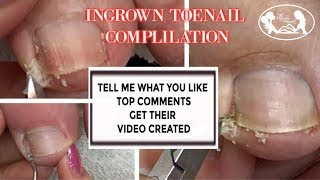Pedicure Ingrown Toenail Relief Compilation with Slo Motion Pedicure Ingrown Toenail Relief Compilation with Slo Motion