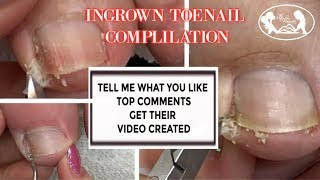 Pedicure Ingrown Toenail Relief Compilation with Slo Motion