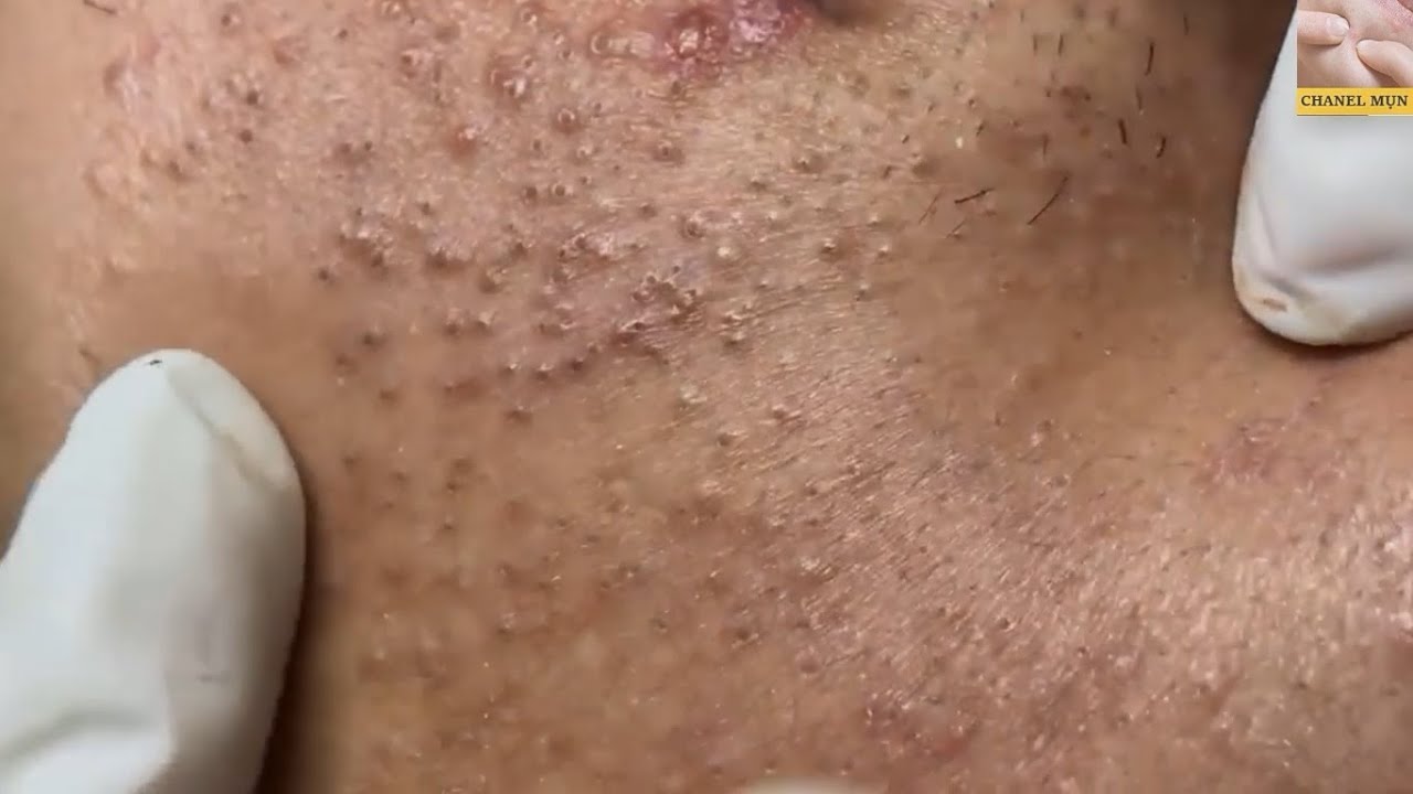 blackheads removal youtube 2019 #14 | nặn mụn đầu đen | mụn bọc | mụn trứng cá | mụn ẩn #14