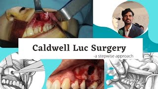 Caldwell-Luc Surgery