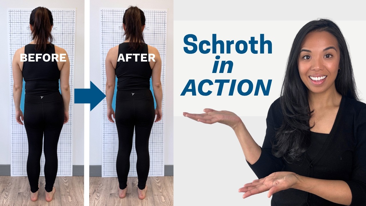 Inside a REAL Schroth Treatment Session for Scoliosis (with results!)