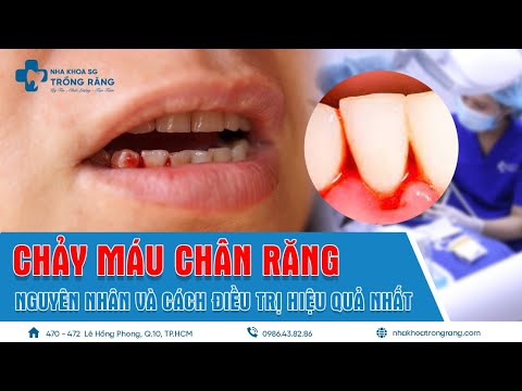 Video Tại sao bạn bị chảy máu chân răng? - Hãy nghe chuyên... - youtube