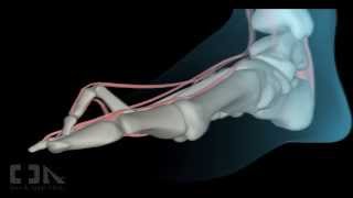 Minimally Invasive  Rigid Hammertoe Surgery