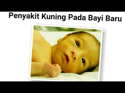  Penyakit Kuning Pada Bayi Penyebab Ciri Bahaya dan Cara 