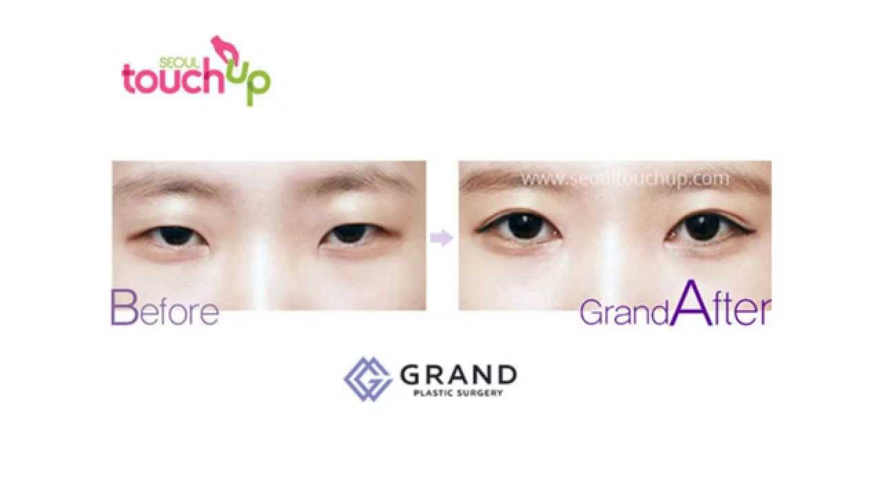 double eyelid surgery, double eyelid surgery cost, korean doubl...