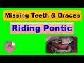 Missing Teeth &amp; Braces, Riding Pontic