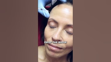 VOORHOOFDRIMPELS VERDWENEN - VOOR EN NA