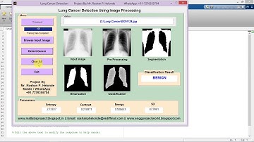 Matlab Code for Lung Cancer Detection Using Image Processing IEEE Based Project