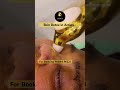 Skin Detox Facial Cupping ✨ Instant Glow Therapy | No Needles | No Downtime