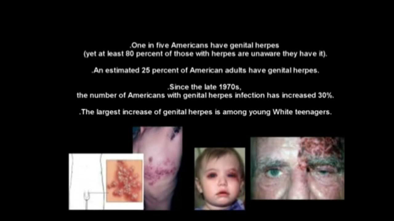 herpes-permanent-cure-drerayo-youtube