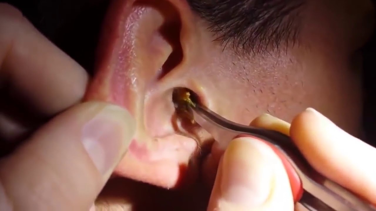 New OMG !!! Top Giant Ear Wax Removal Biggest Ear Wax Removal Extremely