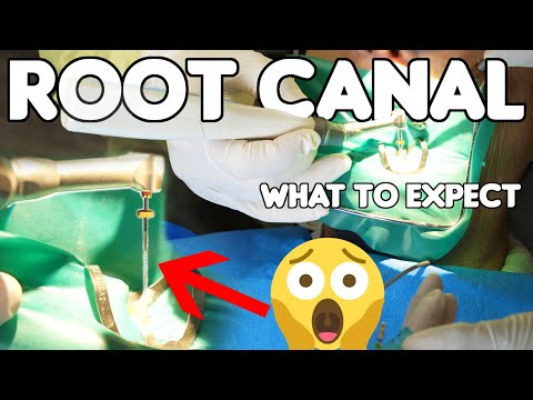 What&rsquo;s Really Happening During A Root Canal Procedure