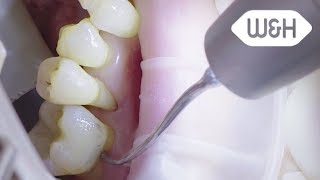 Tigon+ and periodontology tips 4P, 5PI, 5P (English)