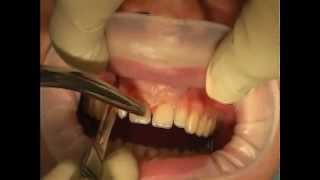 LIVE OPERATION Root Tip Resektion with orthograde filling