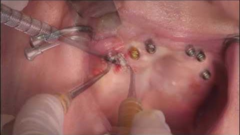 Removal of Failed Dental Implant and Site Bone  Graft