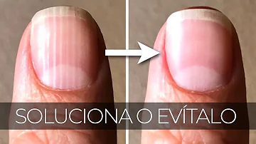 ¿Qué vitamina te falta cuando tienes estrías en las uñas?