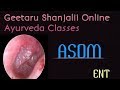 ASOM Acute Suppurative Otitis Media By Geetaru Gitaru Shalakyatantra ENT Bams AYURVEDA BAMS ASOM Acute Suppurative Otitis Media By Geetaru Gitaru Shalakyatantra ENT Bams AYURVEDA BAMS