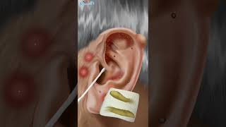 asmr Pimple blackhead and sebaceous cyst removal ear pain animation satisfyingvideo