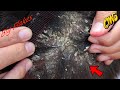 Satisfy Dandruff Removal