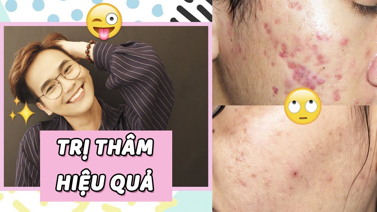 Sản Phẩm Trị Thâm Mụn Hiệu Quả ♡ Drugstore | Mid-end | High-end ♡ DungOiDungA